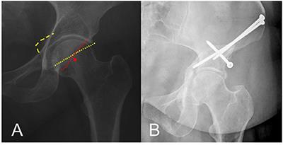 Case Report: Intraarticular Iliopsoas Tendon causes Groin Pain Following Periacetabular Osteotomy